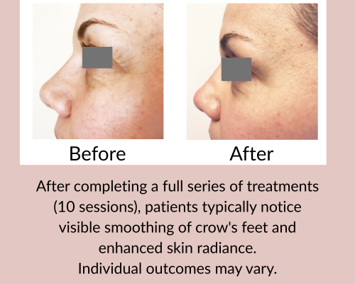 real before and after of facial acupuncuture done in mississauga
