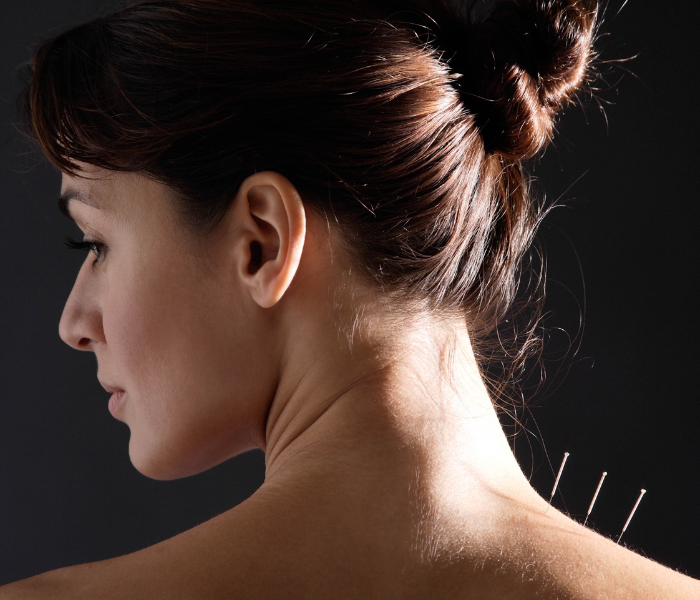 Stock photo of a relaxed patient with acupuncture needles on shoulders