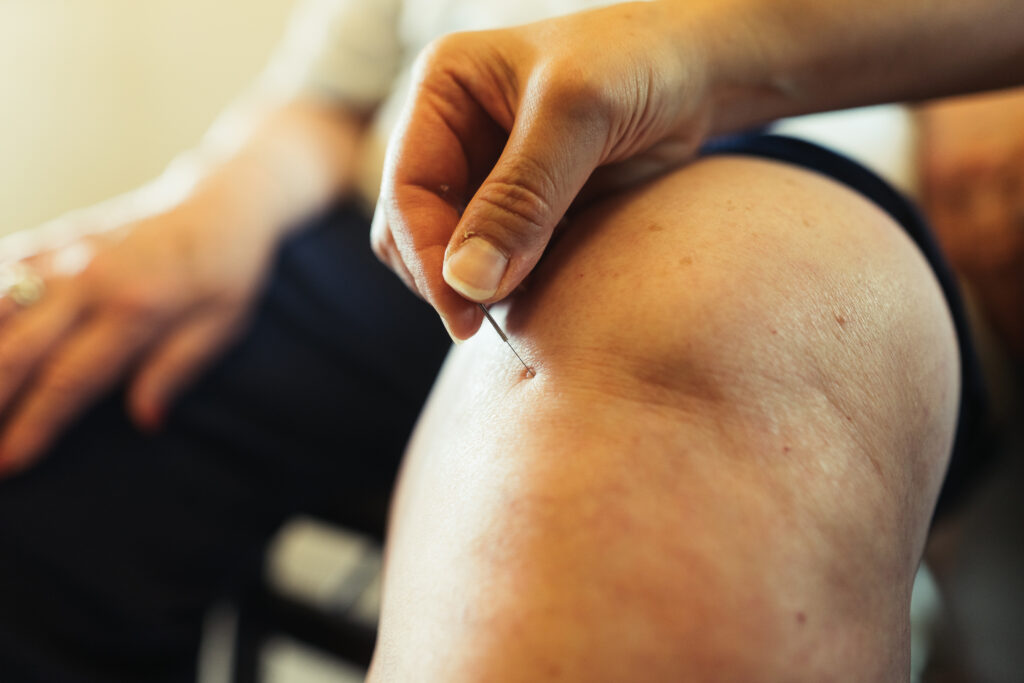 Patient receiving acupuncture for knee pain with sterile needles placed around the knee