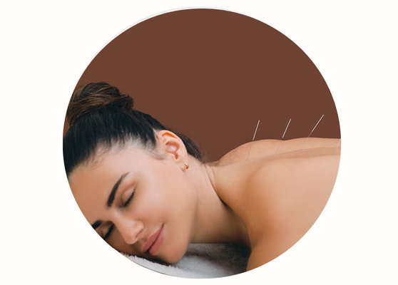 Stock photo representing patient getting acupuncture at Acupuncture Heals in Mississauga, ON